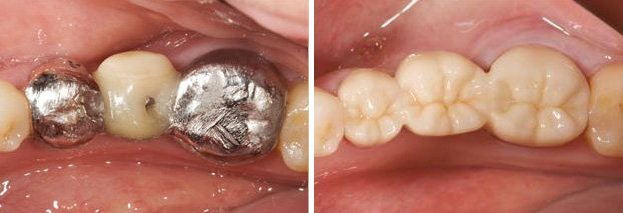 metal free crowns dental care of walnut creek