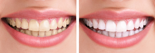 teeth whitening dental care of walnut creek